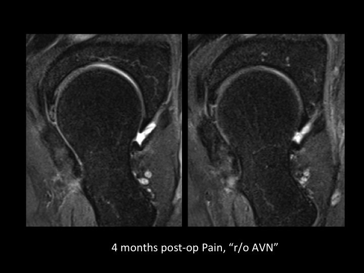Figure 2 for case acetabular labrum ( RID2644 )